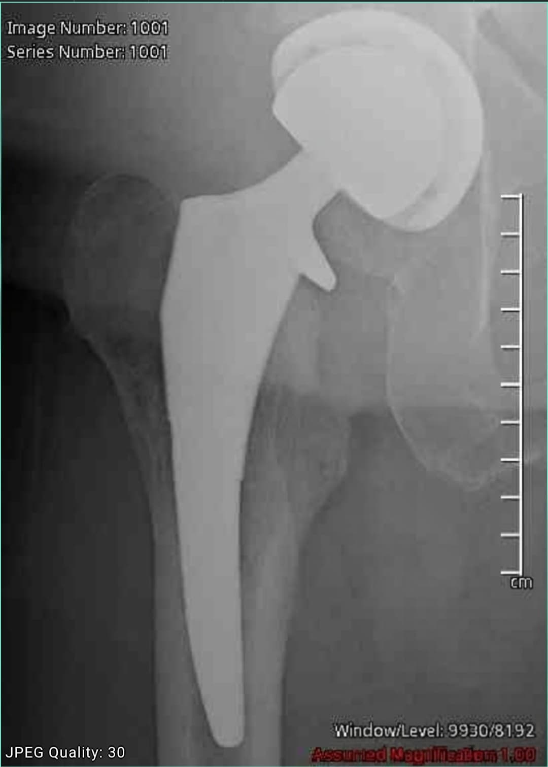 Post-surgery x-ray showing total hip replacement